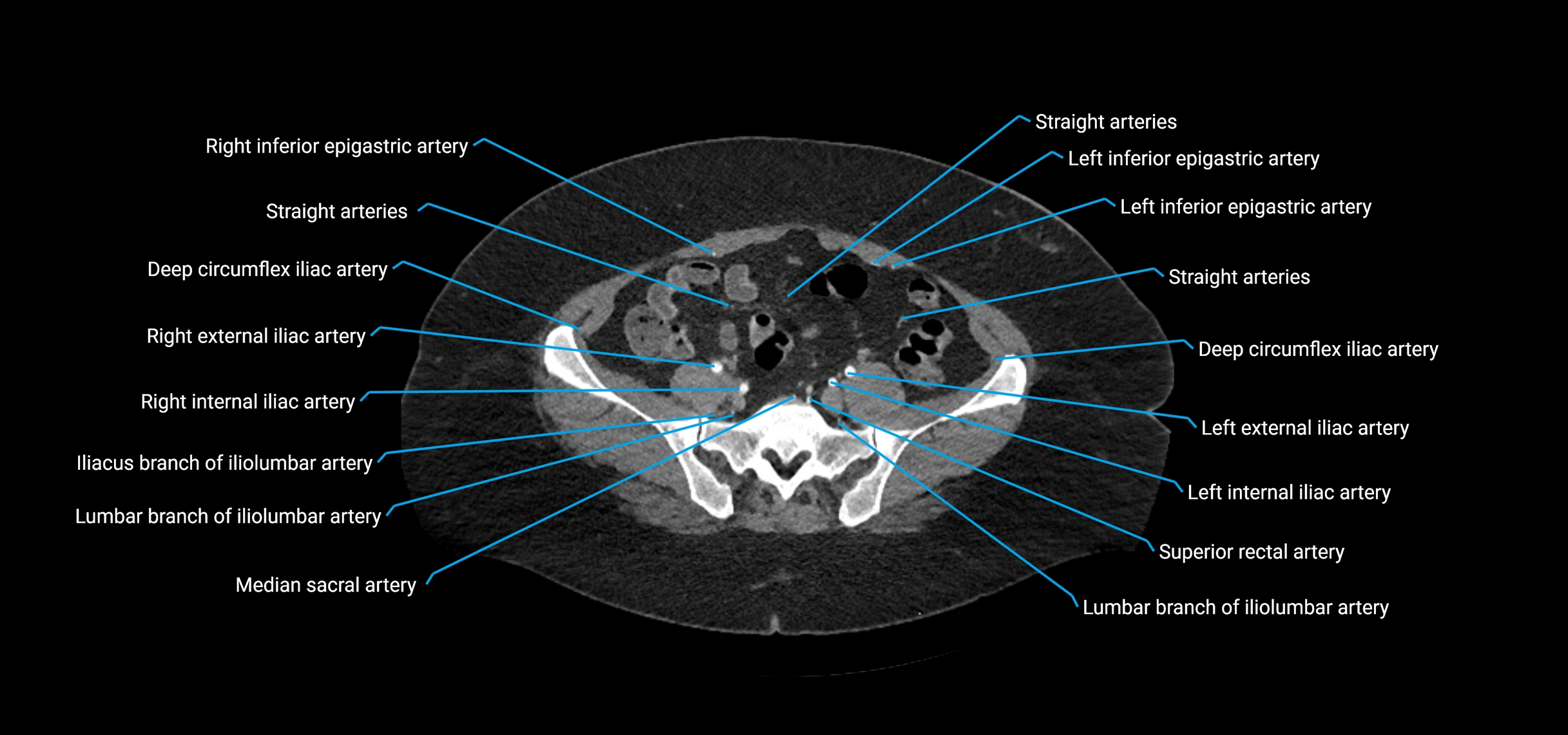 CTA abdomen axial cross sectional anatomy labelled image_184 (2).webp